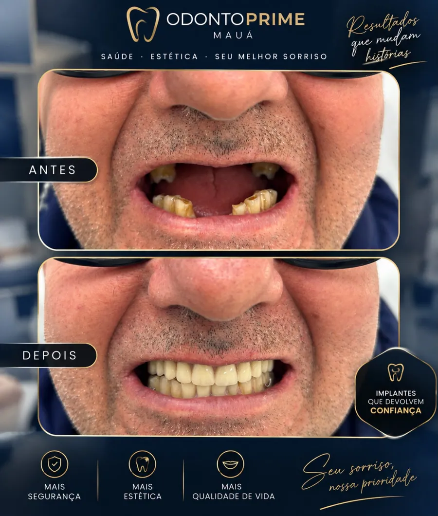 Antes e depois de reabilitação com próteses na Odonto Prime Mauá