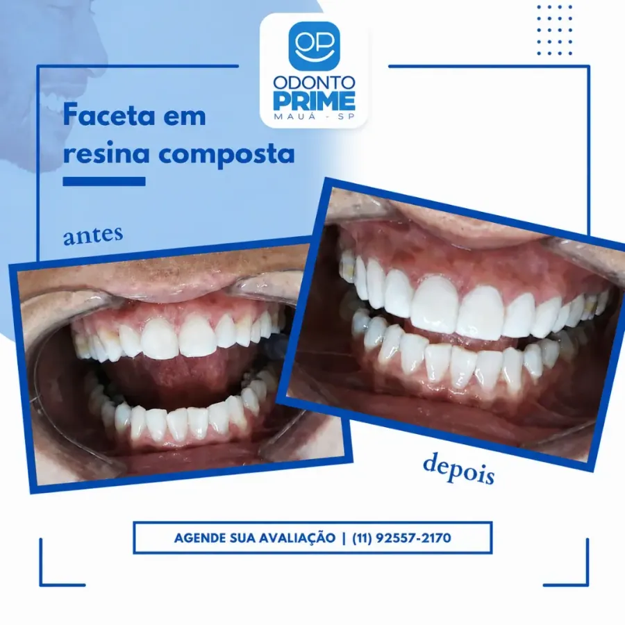 Antes e depois de facetas em resina composta