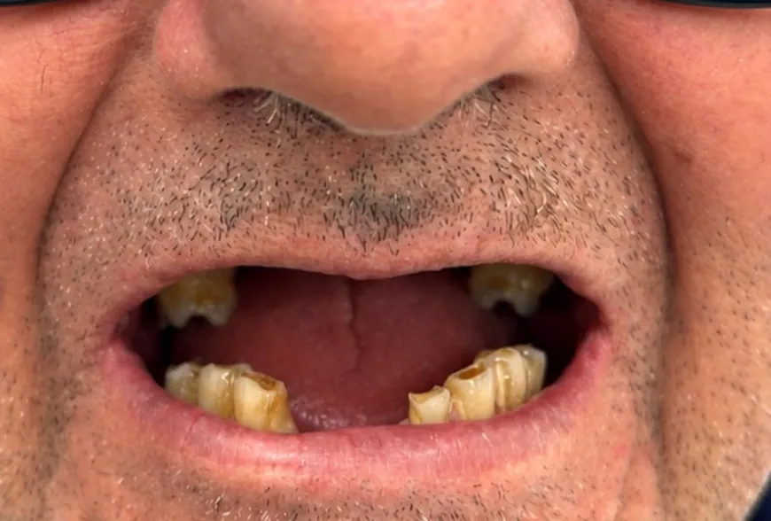 Antes: paciente com vários dentes ausentes e desgastados
