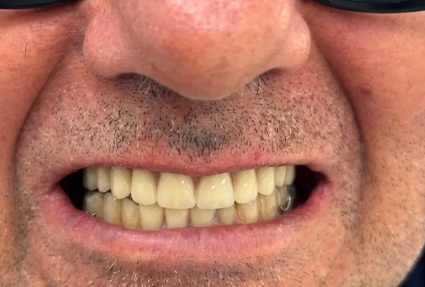 Depois: mesmo paciente com sorriso reabilitado por próteses